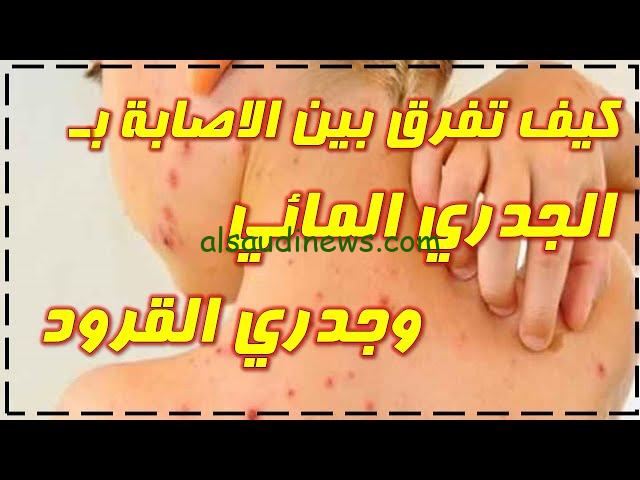 مقارنة شاملة.. ما هو الفرق بين جدري الماء وجدري القرود وأيهم أخطر ومميت
