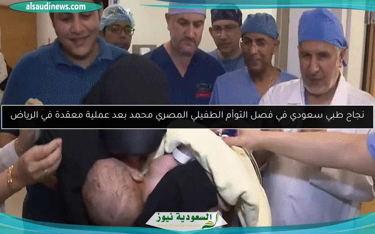 نجاح طبي سعودي في فصل التوأم الطفيلي المصري محمد بعد عملية معقدة في الرياض