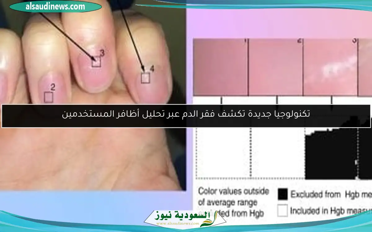 تكنولوجيا جديدة تكشف فقر الدم عبر تحليل أظافر المستخدمين